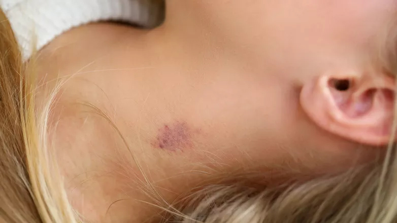 Hoe haal je een zuigzoen weg?